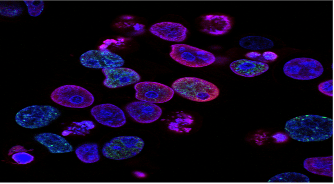Potencial Avanço no Tratamento do Câncer de Próstata Metastático Surge