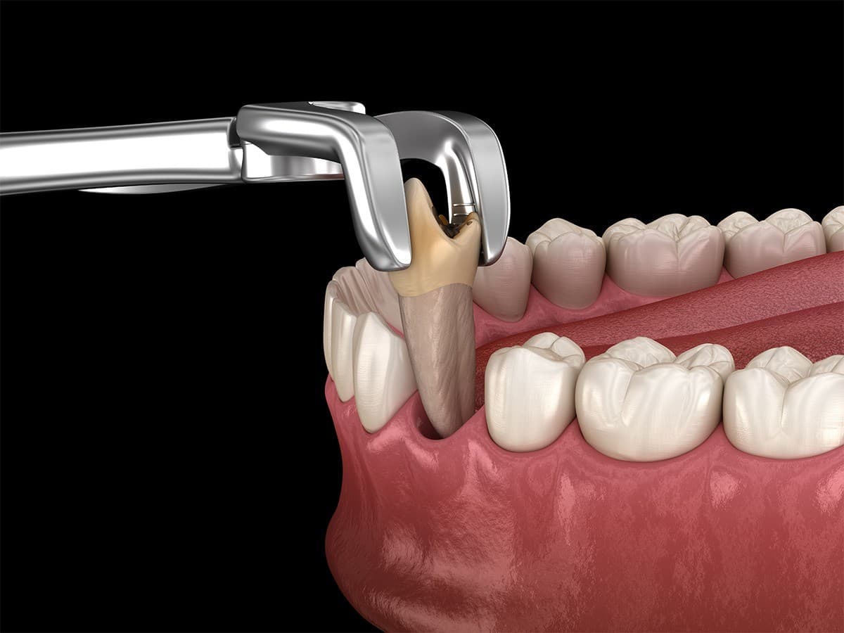 Clínica de Cirurgia Oral de Sioux Falls Publica Guia para Reduzir Ansiedade de Pacientes sobre Extrações Dentárias