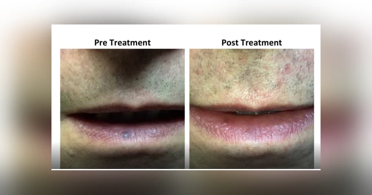 Cirurgião Vascular de Clifton Oferece Tratamento a Laser para Lago Venoso, uma Lesão Labial Comum, mas Pouco Reconhecida