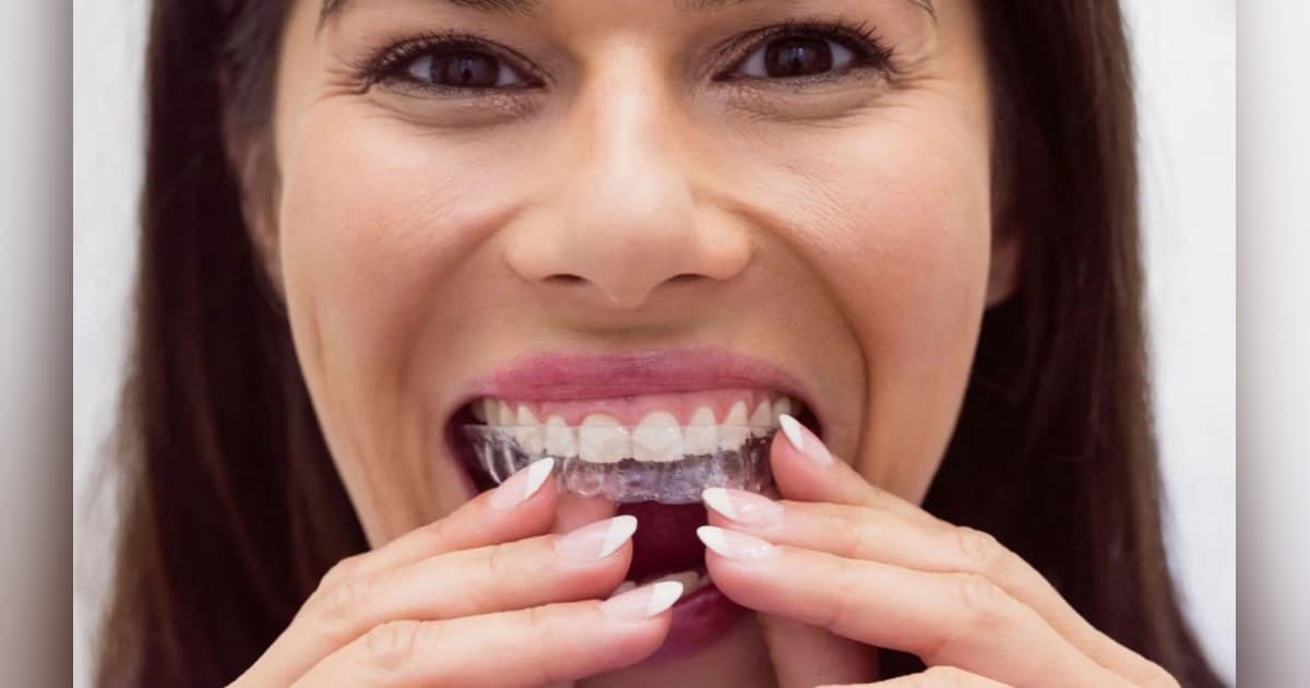 Sherman & Balhoff Orthodontics oferece alinhadores transparentes para tratamento de sobremordida e mordida cruzada em Baton Rouge